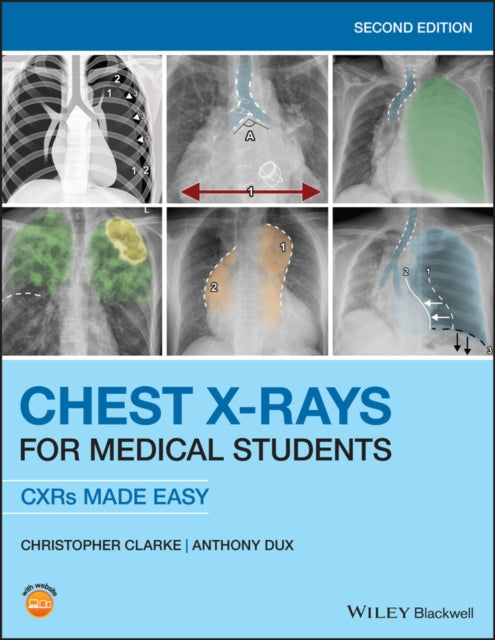 CHEST X-RAYS FOR MEDICAL STUDENTS: CXRS MADE EASY