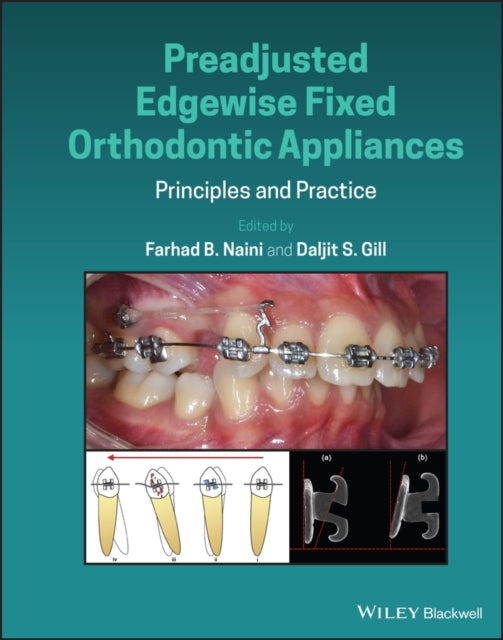 PREADJUSTED EDGEWISE FIXED ORTHODONTIC APPLIANCES