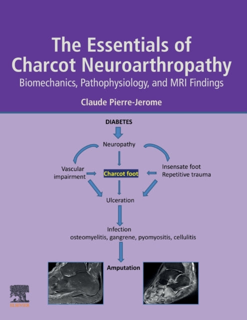 The Essentials of Charcot Neuroarthropathy - Biomechanics, Pathophysiology, and MRI Findings