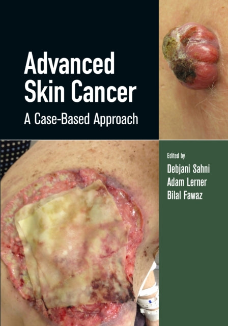 Advanced Skin Cancer - A Case-Based Approach