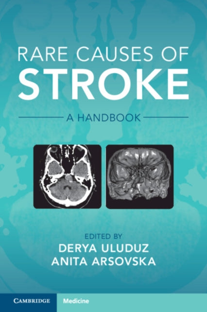 Rare Causes of Stroke - A Handbook