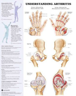 Understanding Arthritis Anatomical Chart